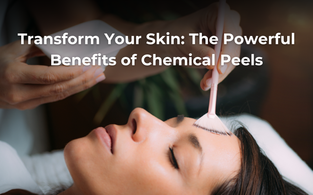 Transform Your Skin: The Powerful Benefits of Chemical Peels