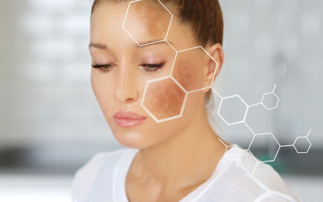 How to Treat Hyperpigmentation with Chemical peels