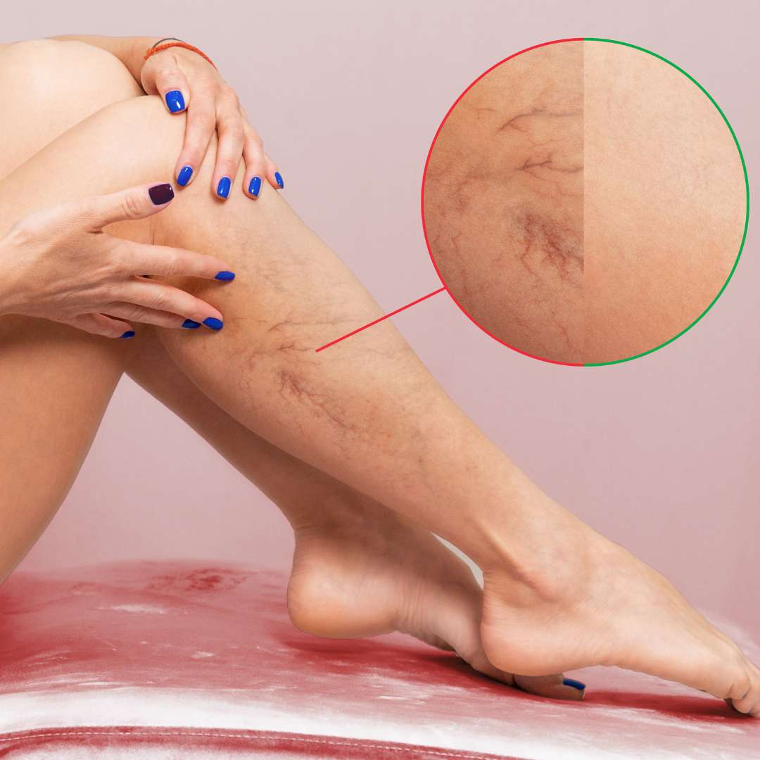 Spider Vein Treatment at Las Vegas Skin Pros Before and After Spider Vein Treatment at Las Vegas Skin Pros Before and After