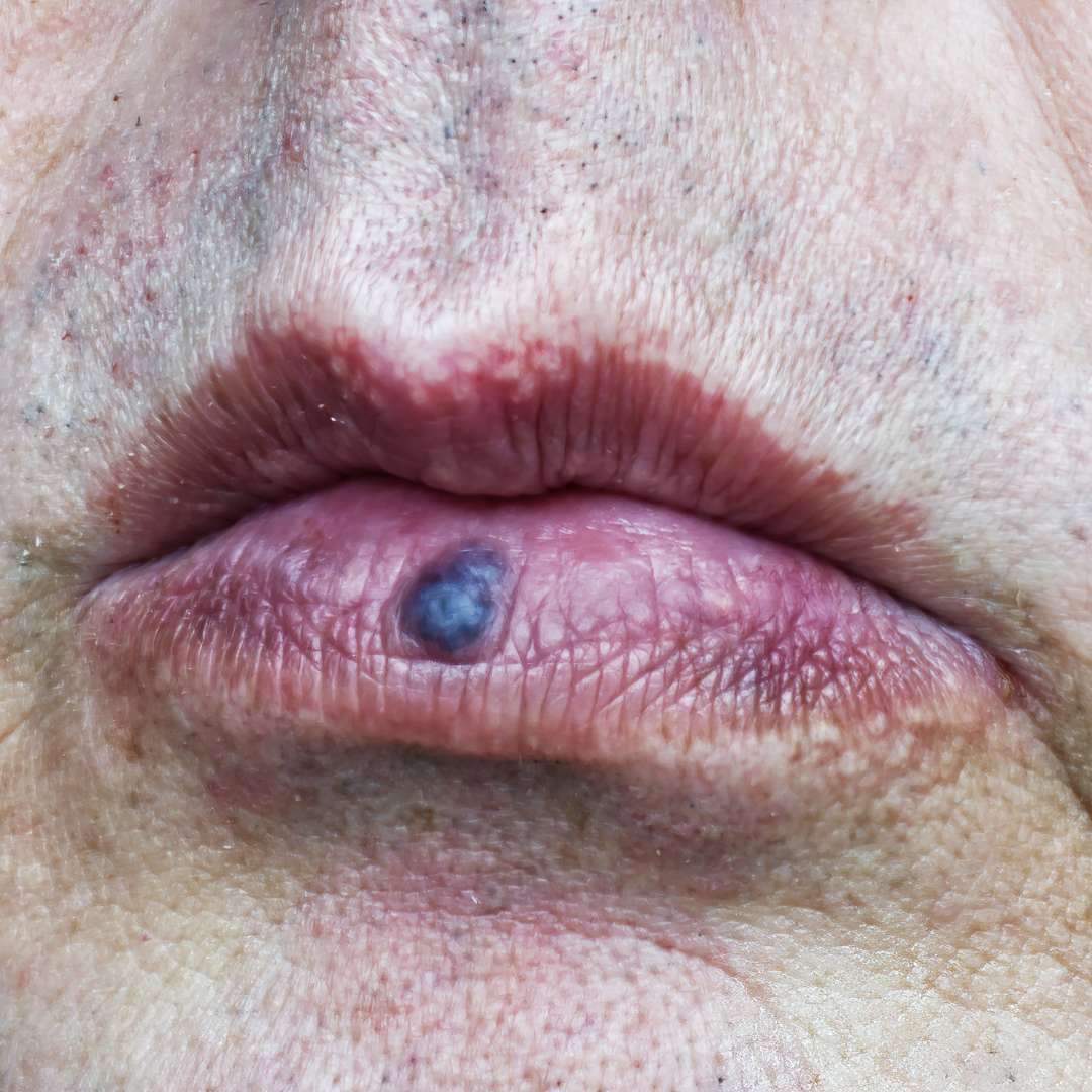 Venous Lake Treatment at Las Vegas Skin Pros on Lip Venous Lake Treatment at Las Vegas Skin Pros on Lip