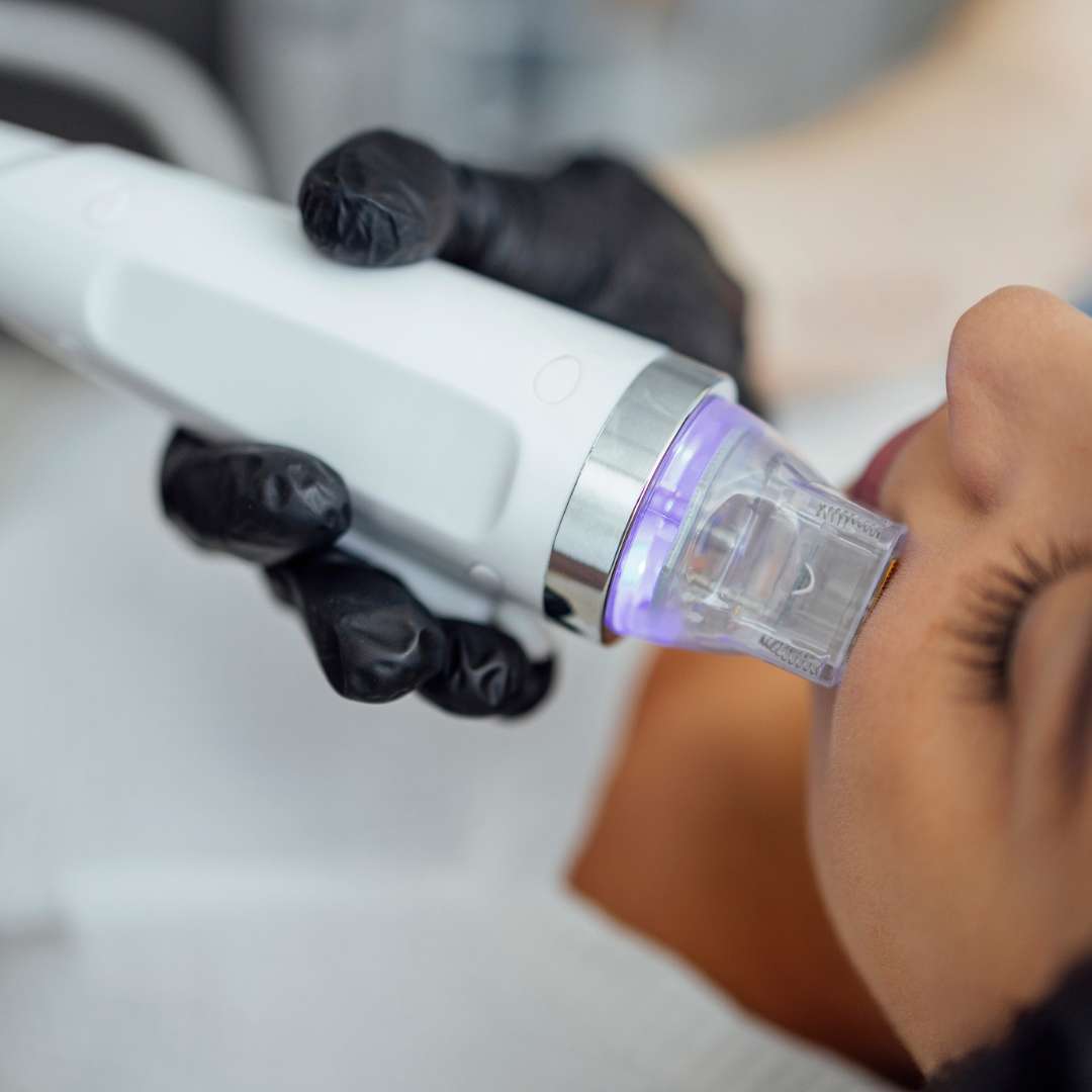 How is The Collagen Boosting Microneedling Procedure Done