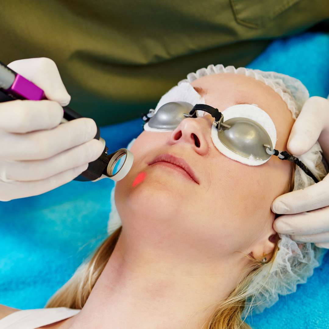 Advanced acne laser resurfacing treatment at Las Vegas Skin Pros