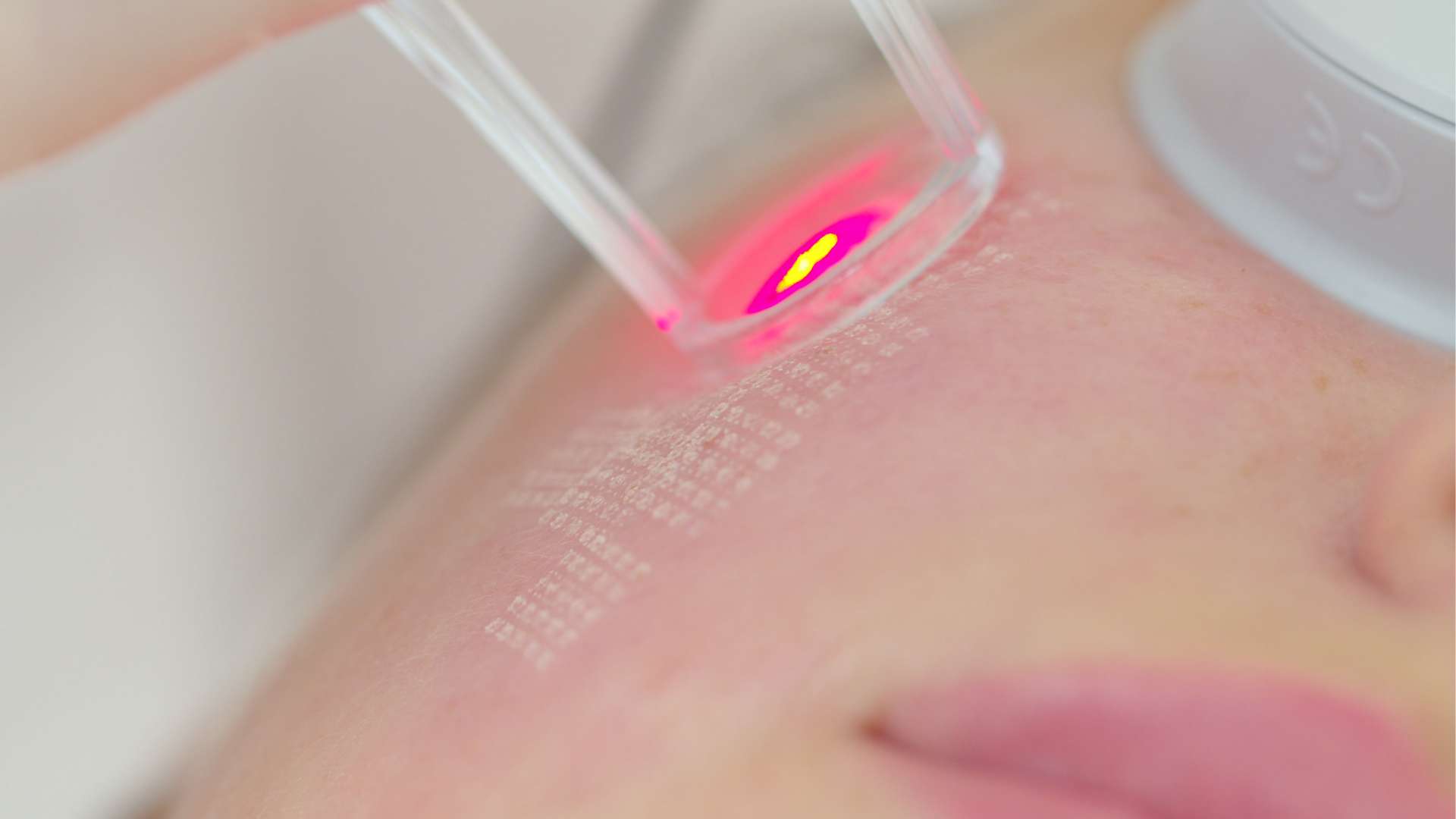 Skin resurfacing treatment at Las Vegas Skin Pros