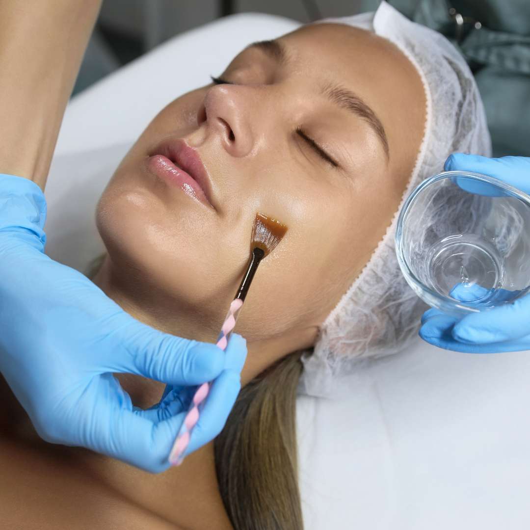 What is An Anti-Aging Chemical Peel What is An Anti-Aging Chemical Peel