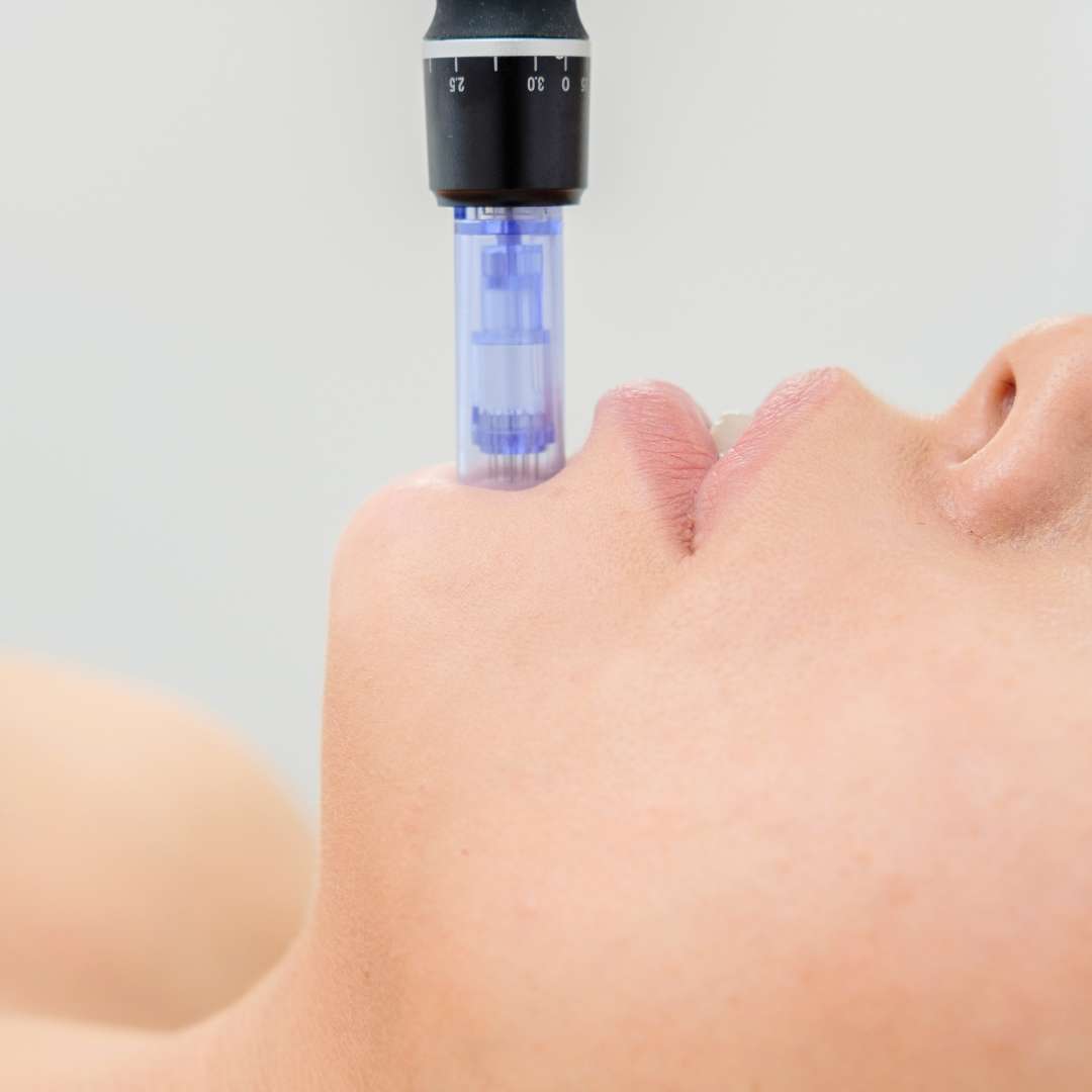 What is a Collagen boosting microneedling Treatment
