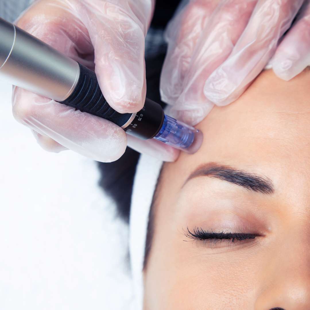 Youth Renewal with Exosomes at Las Vegas Skin Pros Microneedling