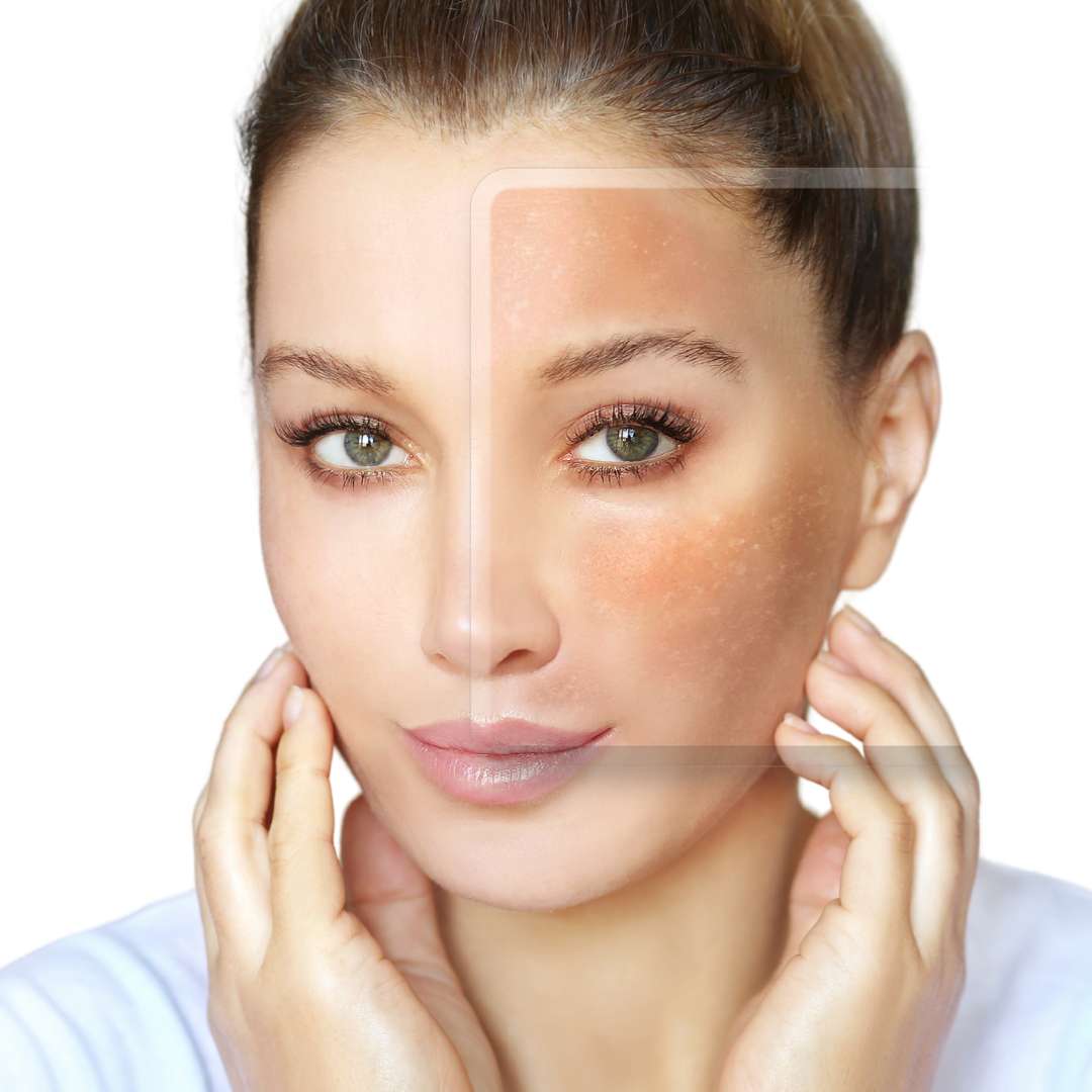 Melasma Control at Las Vegas Skin Pros